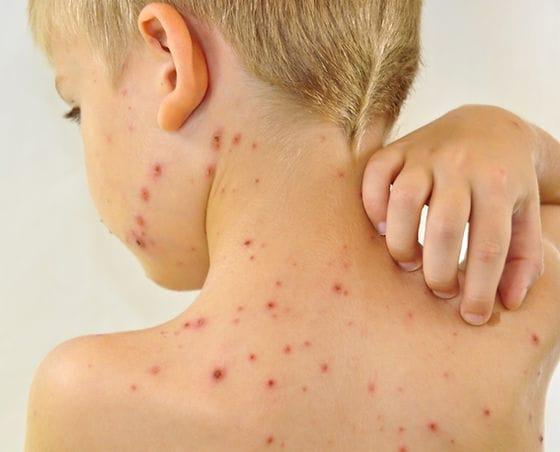 В Джалал-Абаде из-за вспышки кори две школы отправлены на дистанционное обучение